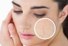 面部長痘如何進行祛痘護理