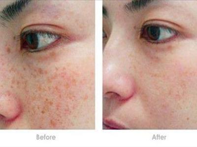 女性激光祛斑會反彈嗎,醫(yī)美后五個注意事項