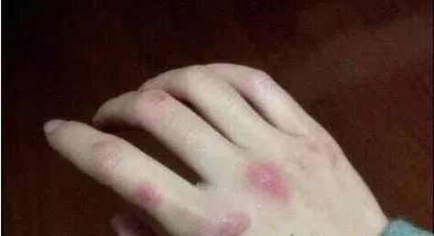 冬天天氣冷長凍瘡怎么辦?6個小妙招教給你-易網健康養生網 冬天天氣冷長凍瘡怎么辦?6個小妙招教給你