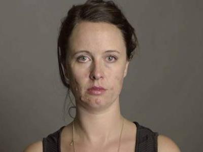 嘴巴周圍長(zhǎng)痘的原因，困擾女生的痘痘問題四招解決