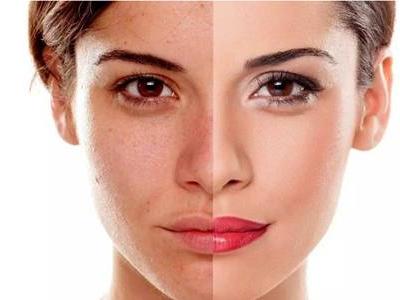 光子嫩膚的危害缺陷,醫(yī)美光子嫩膚術(shù)后的注意事項