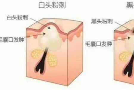 油性皮膚會有哪些肌膚問題 如何改善油性皮膚問題