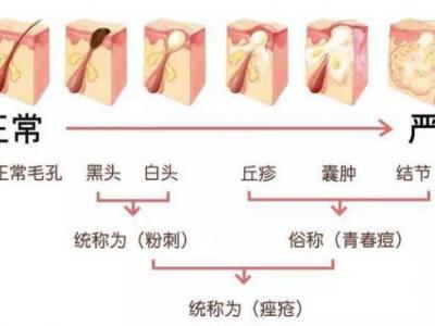 臉上長痘痘怎么調理？做好這三點讓痘痘遠離你