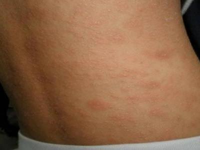 玫瑰糠疹皮膚病怎么引起的，治療方法中忌口這五種食物