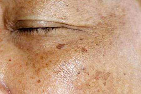 臉上長斑怎么辦如何調理  長斑的原因是怎么引起的身體有什么問題