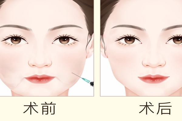 面部溶脂針副作用