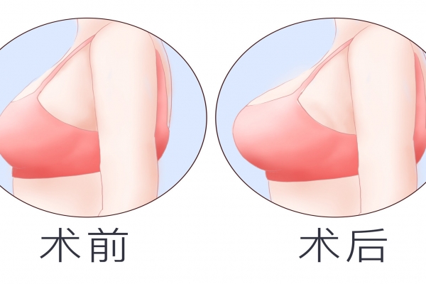 整形隆胸手術好不好