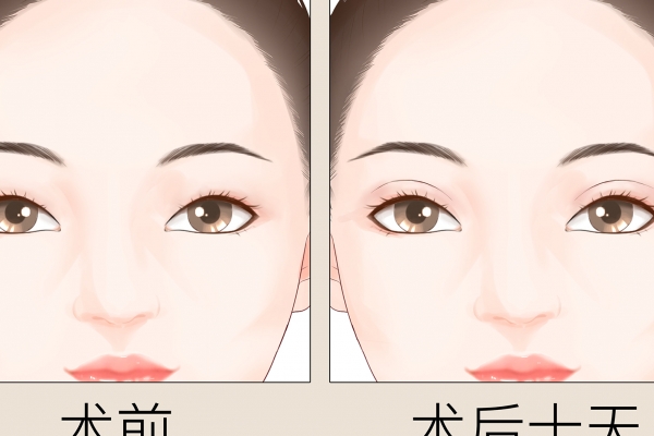 割雙眼皮好不好-易網<a href=http://m.logojc.com/ target=_blank class=infotextkey>健康養生</a>網 割雙眼皮好不好