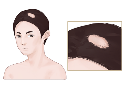 油脂性脫發(fā)該怎么辦