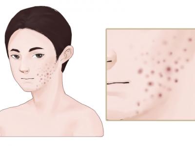 什么是激素臉,怎么造成的