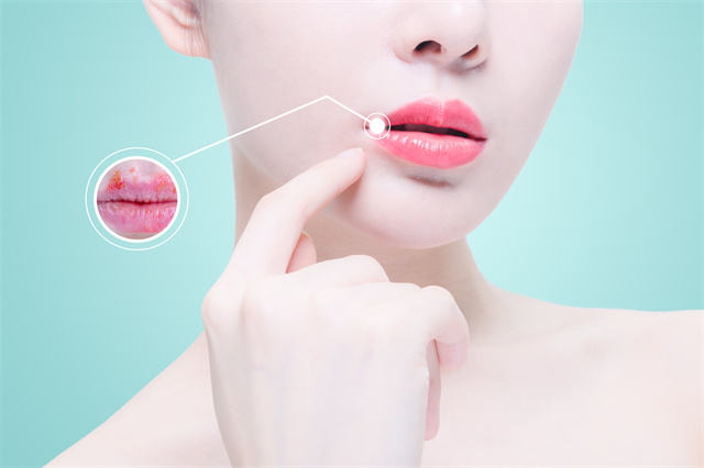 春天嘴唇經常干裂怎么辦?這些妙招幫你緩解-易網<a href=http://m.logojc.com/ target=_blank class=infotextkey>健康養生</a>網 春天嘴唇經常干裂怎么辦?這些妙招幫你緩解