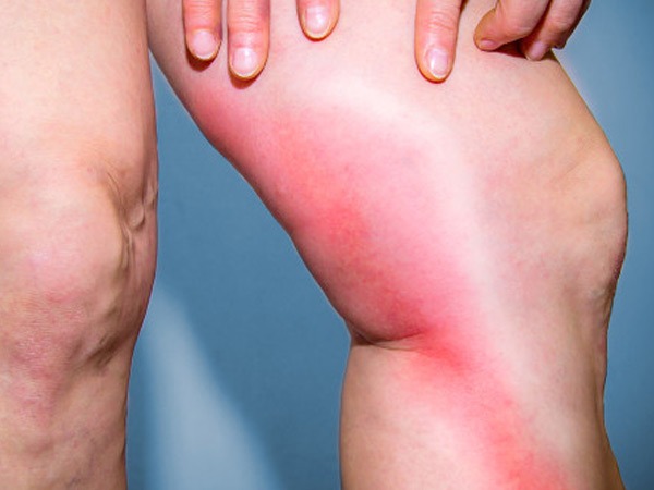 秋季來臨 需防“老寒腿”-易網健康<a href=http://m.logojc.com/jkys/ target=_blank class=infotextkey>養生</a>網 秋季來臨 需防“老寒腿”