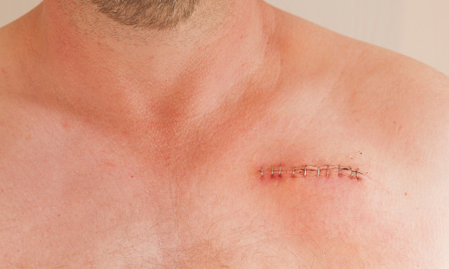 疤痕體質患者在日常生活中該如何預防疤痕?-易網健康養生網 疤痕體質患者在日常生活中該如何預防疤痕?