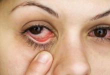 眼睛有血絲怎么辦 8個方法推薦
