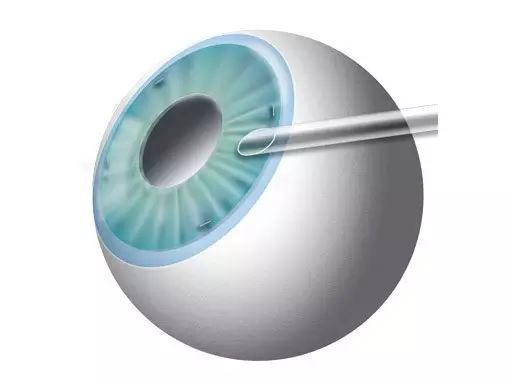 高度近視朋友需要預(yù)防六種常見并發(fā)癥 高度近視朋友需要預(yù)防六種常見并發(fā)癥