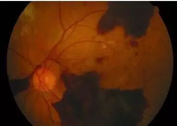 糖尿病會導致眼睛失明,視力模糊是前期征兆! 糖尿病會導致眼睛失明,視力模糊是前期征兆!