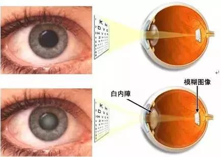都是視力下降!白內(nèi)障、老花眼有何不同? 都是視力下降!白內(nèi)障、老花眼有何不同?