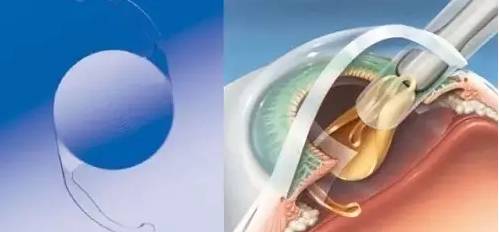 白內障患者如何選擇適合自己的手術晶體？