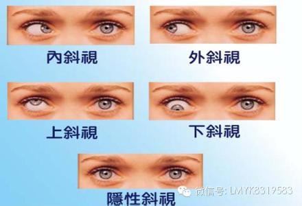 小兒斜視什么時(shí)候做最好？