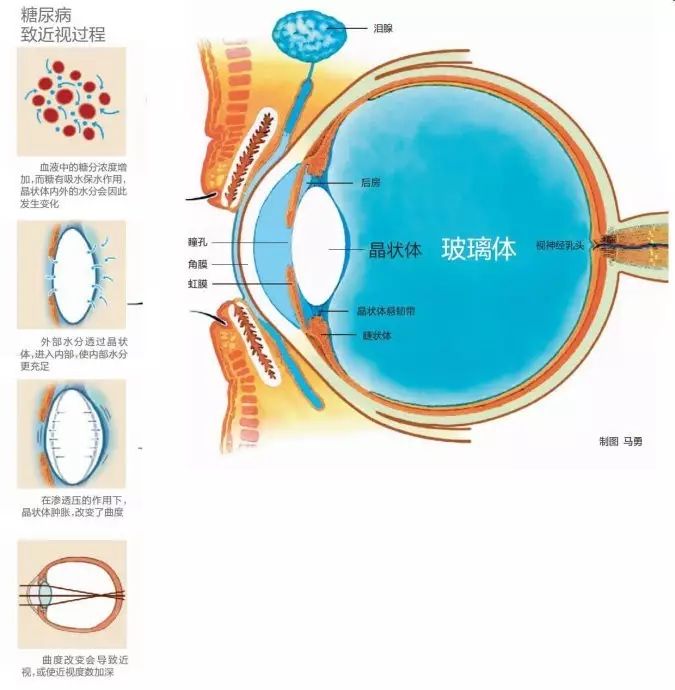 糖尿病會導致眼睛失明,視力模糊是前期征兆! 糖尿病會導致眼睛失明,視力模糊是前期征兆!