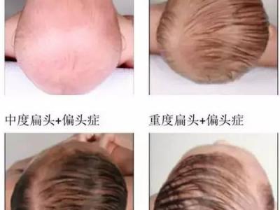 雙眼皮術前術后的注意事項