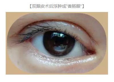雙眼皮術后出現上瞼下垂怎么辦？