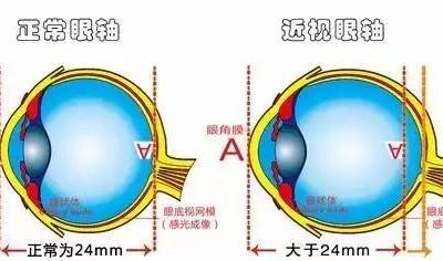 弱視是怎么形成的？它與近視有哪些區別？