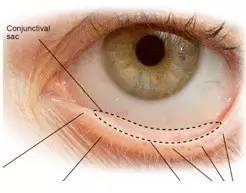 點眼藥水的正確步驟和姿勢