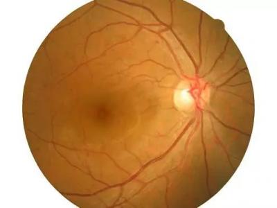 白內障術后仍然模糊怎么回事？