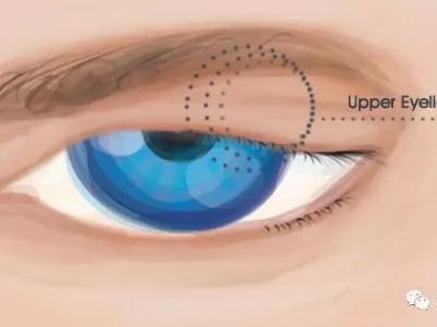上瞼下垂知多少？
