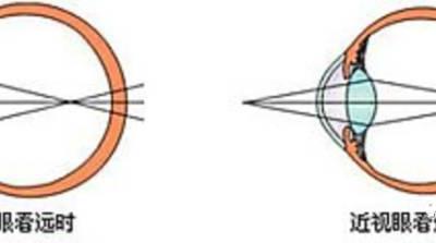 眼疲勞防治,你需要知道的那些事