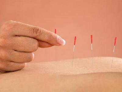 持續性耳鳴怎么用針灸治療 中醫針灸治療持續性耳鳴的4個方法